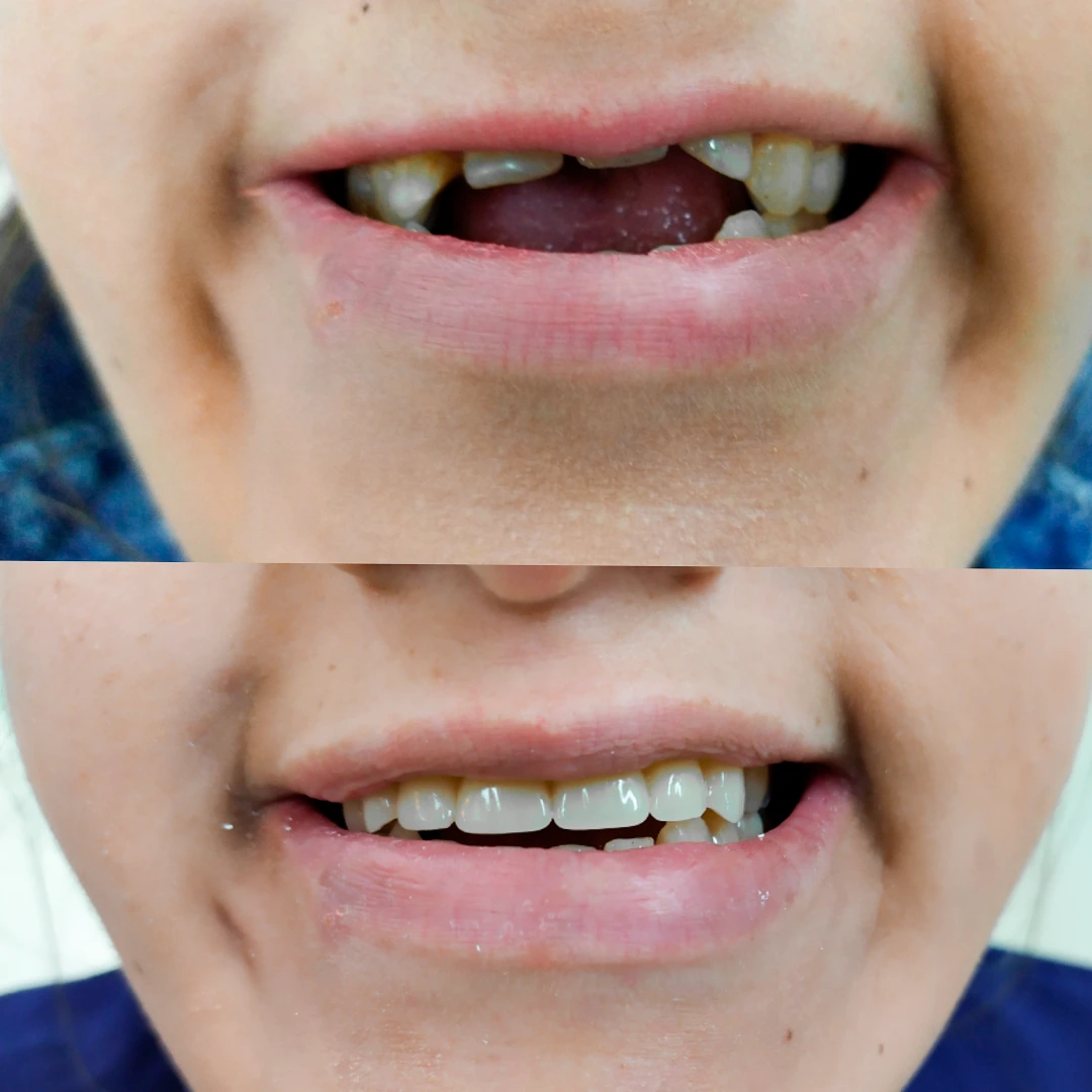 Antes e depois 1