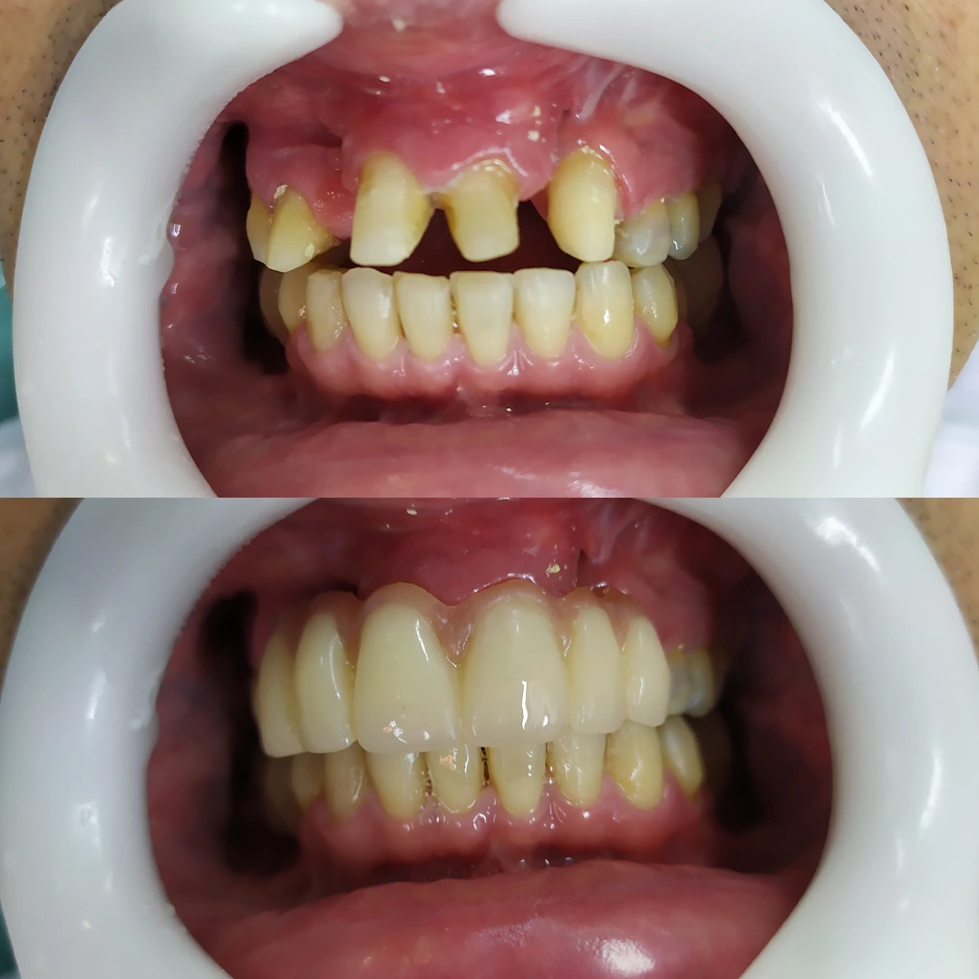 Antes e depois 4