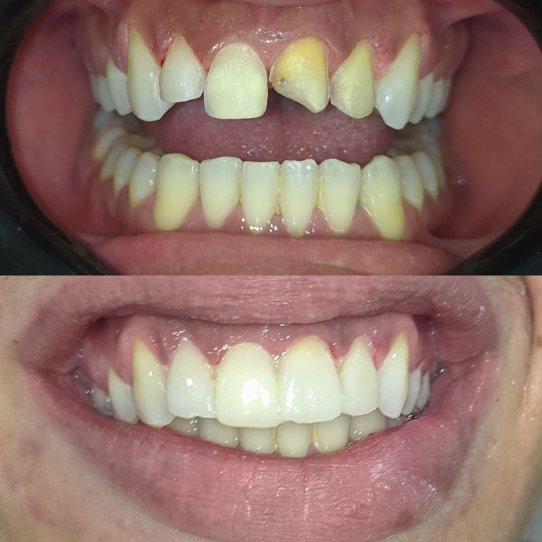 Antes e depois 2