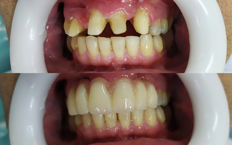 Tratamento com implantes dentários